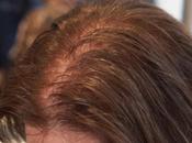 Women’s Hair Loss Isn’t Just Cosmetic Issue| Female Pattern Loss- Diagnosis Treatment Transplant Specialist