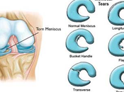 Meniscus Tear Types What They Treat Them Properly