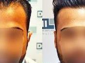 Searching Best Hair Transplant Chennai? Your Needs Covered!