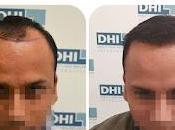 Choose Best Hair Transplant Surgeon Chandigarh Guaranteed Results