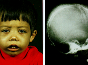 Global Beta-thalassemia (B-thal) Market Research Report 2021-2028 |Key Players, Growth Analysis, Share, Trends