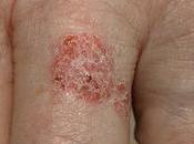 Need Know About Bowen Disease Treatment