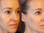 Easiest Method Performing Dermal Filler Beauty Therapist
