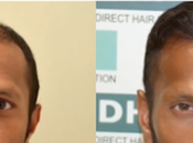 Choose Best Hair Transplant Guwahati?