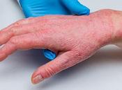 Psoriatic Arthritis Treatment Market: Global Analysis Trends, Share, Size, Growth, Opportunity Forecast 2021 2028