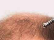 Possible Failed Hair Transplant?