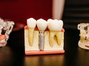 Important Things Need Know Before Getting Dental Implants