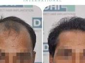 What Hair Transplant Cost Guwahati?