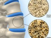 Osteoporosis Drugs Market Global Industry Analysis, Pipeline Size, Share, Growth, Trends Forecast 2018 2026
