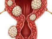 Uterine Fibroid Treatment Devices Market Analysis Development Trends, Business Share, Opportunities, Segmentation Forecast 2018 2026