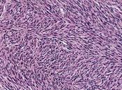 Fibrosarcoma Drugs Market Share Growing Rapidly with Recent Trends, Development, Revenue, Demand Forecast 2018- 2026