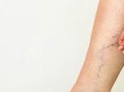 Varicose Vein Treatment Market Challenges, Opportunities, Regions Reports, Drivers, Segment Company Forecast, 2019 2027