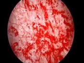 Hunner Ulcers, Symptoms, Causes Diagnosis Ayurvedic Treatment