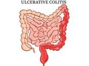 Ulcerative Colitis Market Analysis, Trends, Size, Share, Growth Forecast 2018 2026