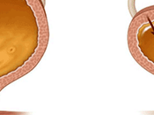 Treatment Overactive Bladder Ayurveda With Herbal Remedies