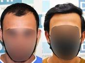 Don't Your Bald Spots Take Away Confidence. Approach Best Hair Transplant Surgeon Chennai
