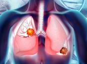 Carcinoid Syndrome Diarrhea Treatment Market Rapidly Increasing Growth Latest Report With Future Estimations, Current Trends Opportunity Analysis 2018-2026