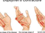 Natural Cure Dupuytren’s Contracture With Herbal Remedies
