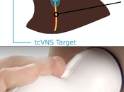 Reduction Stress Inflammatory Responses Transcutaneous Cervical Vagal Nerve Stimulation