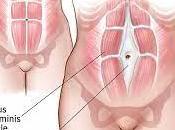 Trimester Woes: Severe Diastasis Recti Hernia, Stretchmarks, Giant Tummy