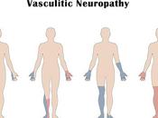 Ayurvedic Treatment Vasculitic Neuropathy With Herbal Remedies