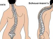 What Difference Between Scheuermann’s Disease Scoliosis?