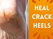 Heal Cracked Heels