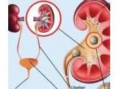 Signs Kidney Stones