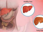 Yakrit Plihantak Churna Fatty Liver Other Disease