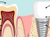 What After Dental Implant Surgery?