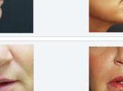 Cheek Filler Before After: Look You’ll Love