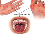 Hand, Mouth Foot Disease Ayurvedic Treatment
