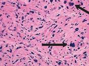 Understanding Myeloproliferative Neoplasm Drugs: Comprehensive Guide