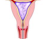 Endometrial Lining Uterus Removed Destroyed During Ablation Surgery