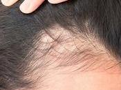 Global Androgenetic Alopecia Treatment Market Expanding Owing Rising Prevalence Hair Loss Growing Rate