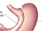 Cheapest Gastric Sleeve Surgery