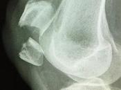 Kneecap Fractures (Patella Fractures)