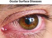 Ocular Surface Diseases Causes, Symptoms, Ayurvedic Treatment