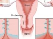 Cervicitis- Ayurvedic View Herbal Treatments
