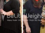750+ Gastric Bypass Before After Pictures Stories