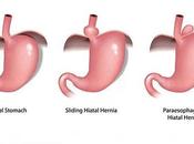 Hiatal Hernia Types, Symptoms, Prevention