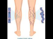 Varicose Veins