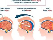 Long Does Post-Concussion Syndrome Last? Factors