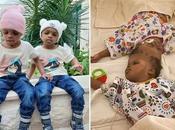 Conjoined Twins Separated with Help from