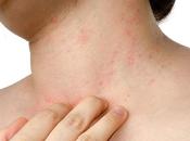 Home Remedies Psoriasis