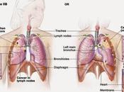 Causes, Symptoms, Treatment, Prognosis Stage Lung Cancer