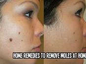 Home Remedies Remove Moles