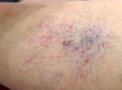 Sclerotherapy Treat Varicose Spider Veins