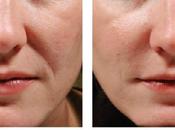 Juvederm Injections Benefits, Cost Side Effects