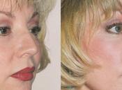 Cheek Augmentation Different Factors Should Consider